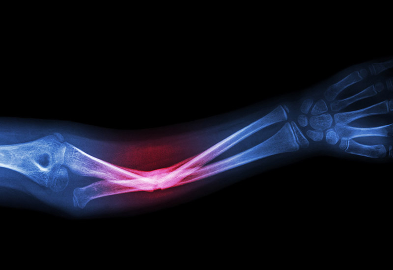 Grover Law Firm Broken Bones